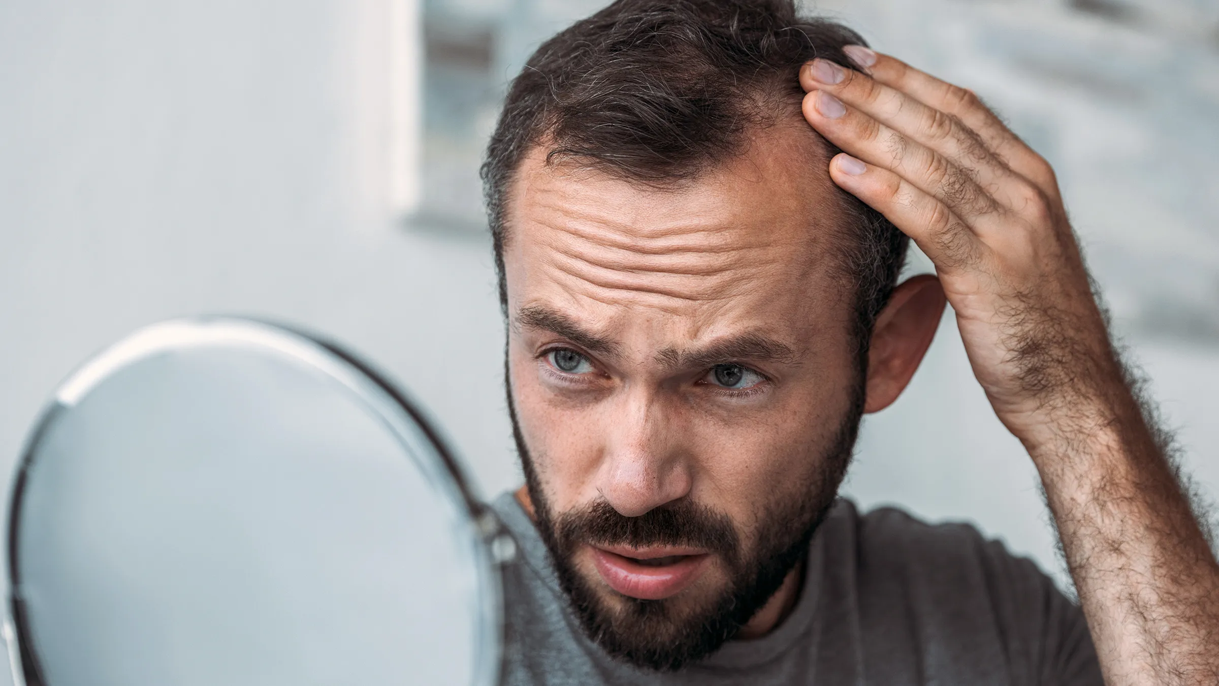 Hair Transplant Before and After – Real Patient Results