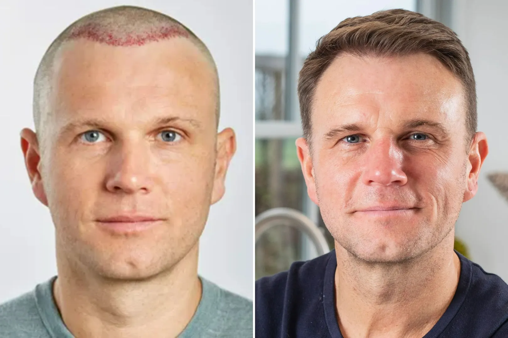 Hair Transplant UK – Everything You Need to Know Before Surgery